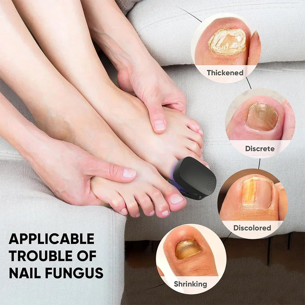 Nail Fungus Cleaning Laser Device – Infrared & Blue Light Therapy