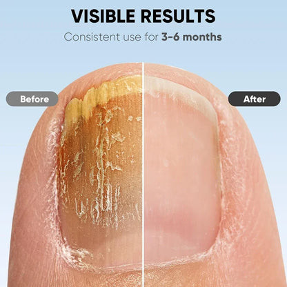 Nail Fungus Cleaning Laser Device – Infrared & Blue Light Therapy