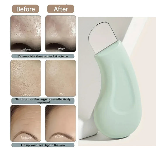 Blackhead & Whitehead Removal Tool - Urbizia